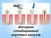 Методики пломбирования корневых каналов