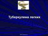 Туберкулема легких