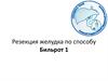 Резекция желудка по способу Бильрот 1