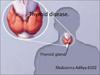 Thyroid disease