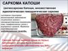 Саркома Капоши, ангиосаркома Капоши, множественная идиопатическая геморрагическая саркома