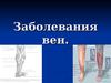 Заболевания вен. Варикозное расширение вен