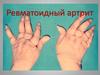 Ревматоидный артрит