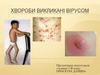 Хвороби викликані вірусом
