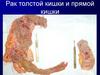 Рак толстой кишки и прямой кишки