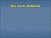 Skin cancer. Melanoma