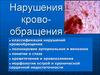 Нарушения кровообращения