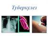 Туберкулез бактериялары кез келген ағзада