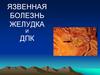 Язвенная болезнь желудка и ДПК