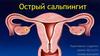 Острый сальпингит