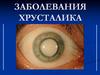Заболевания хрусталика