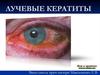 Лучевые кератиты