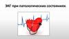ЭКГ при патологических состояниях