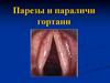 Парезы и параличи гортани