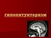 Гипопитуитаризм