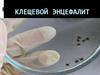 Клещевой энцефалит