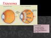 Глаукома. Классификация, лечение