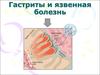 Гастриты и язвенная болезнь