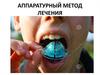 Аппаратурный метод лечения в стоматологии