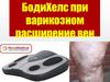 БодиХелс при варикозном расширение вен