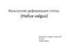 Вальгусная деформация стопы. (Hallux valgus)