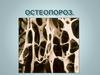 Остеопороз. Диагностика