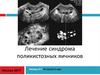 Лечение синдрома поликистозных яичников