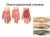 Ожоги различной степени