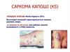 Саркома капоші (ks)