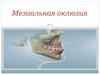 Мезиальная оклюзия