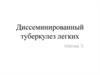 Диссеминированный туберкулез легких