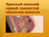 Красный плоский лишай слизистой оболочки полости рта