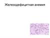 Железодефицитная анемия