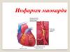 Инфаркт миокарда