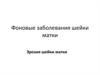Фоновые заболевания шейки матки. Эрозия шейки матки