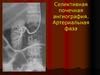 Селективная почечная ангиография. Артериальная фаза