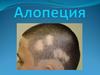 Алопеция. Классификация