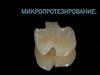 Микропротезирование. Вкладки, виниры. Штифтовый зуб