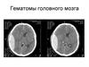 Гематомы головного мозга