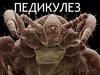 Педикулез