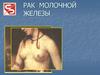Рак молочной железы