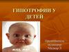 Гипотрофии у детей