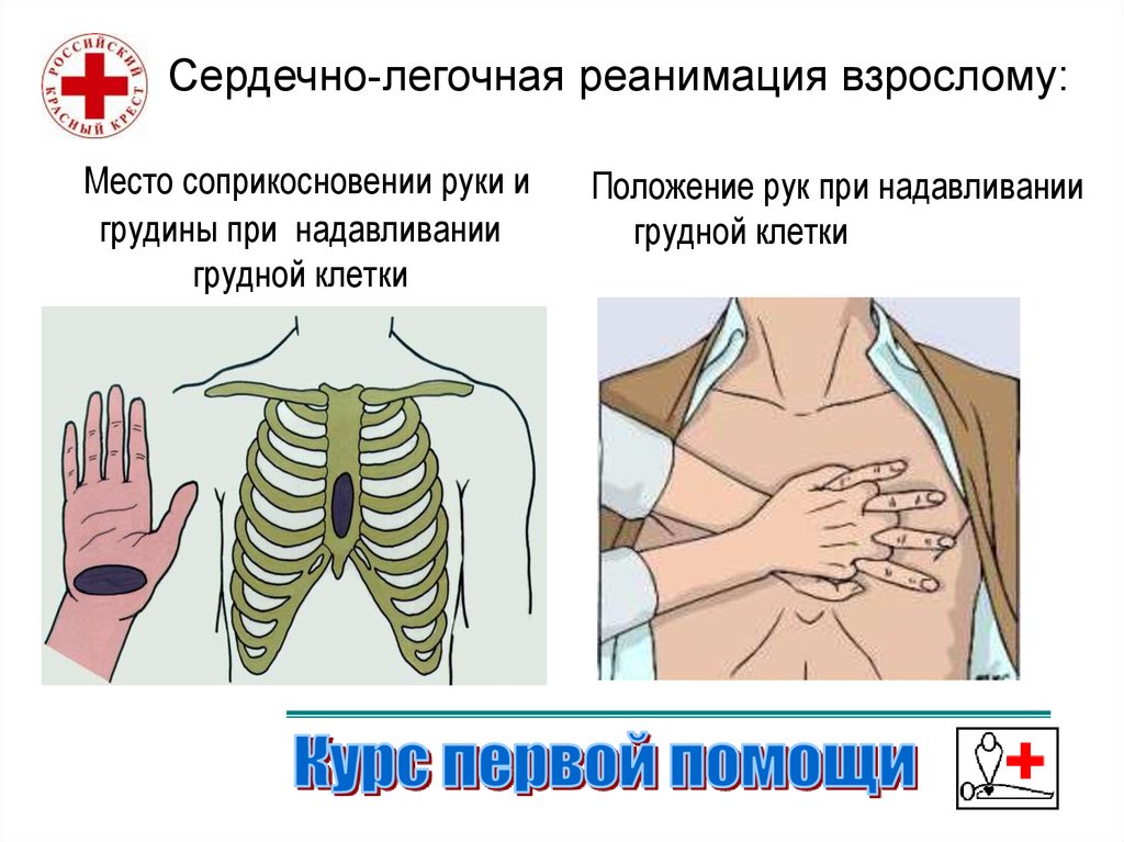 Правильная сердечная реанимация. Постановка рук при сердечно-легочной реанимации. Сердечно-легочная реанимация расположение рук. Правильное наложение рук при СЛР. Расположение рук при сердечно легочной реанимации.