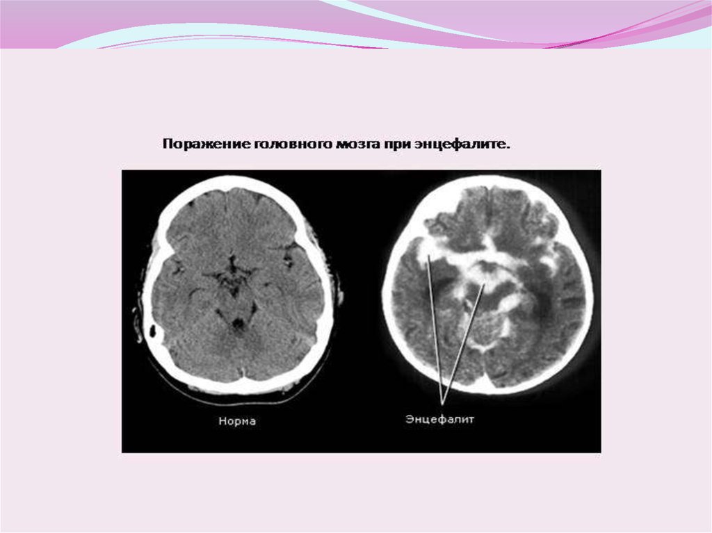 Энцефалит головного мозга у взрослых. Герпетический энцефалит. Менингоэнцефалит на кт головного мозга. Герпетический энцефалит локализация.