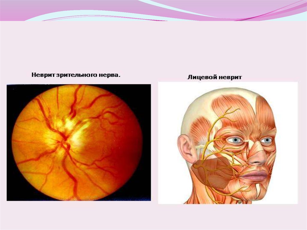 Нейропатия глаза. Неврит зрительного нерва препараты. Неврит зрительного нерва и ретробульбарный неврит. Ретробульбарный неврит глазное дно. H46 неврит зрительного нерва..