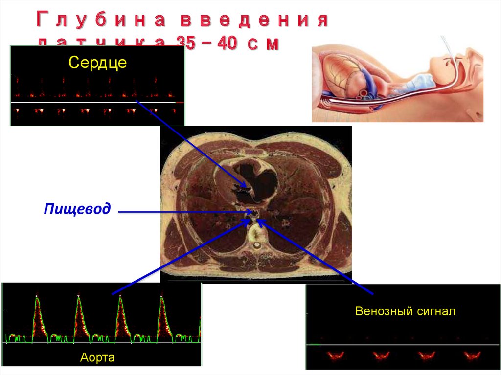Через пищевод. Мониторинг центральной гемодинамики. Через пищеводное УЗИ сердца. Эхокардиография сердца пищевод.