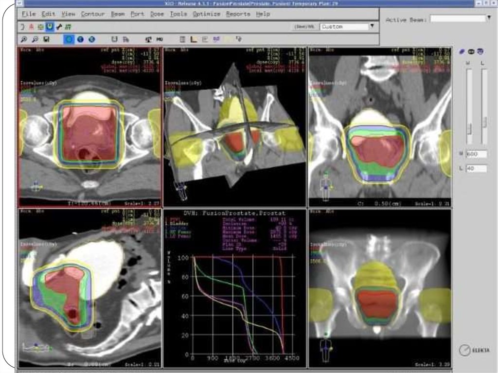 Конформная терапия. Лучевая терапия при онкологии предстательной железы. Дистанционная лучевая терапия предстательной железы. 3d конформная лучевая терапия предстательной железы. Оконтуривание при лучевой терапии.
