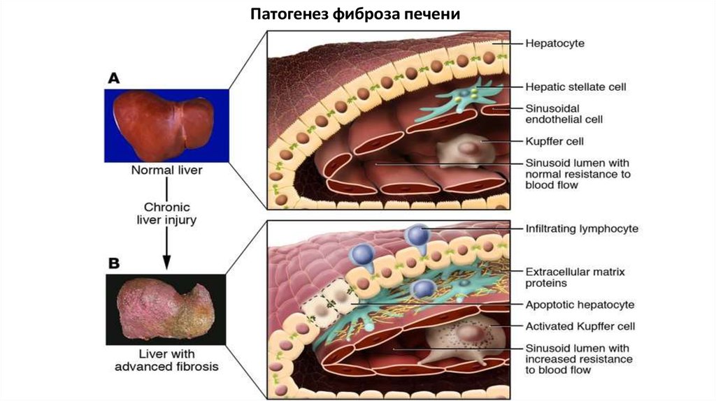 Лечение фиброза печени 3. Механизм развития фиброза печени. Патогенез фиброза печени. Фиброз печени этиология.