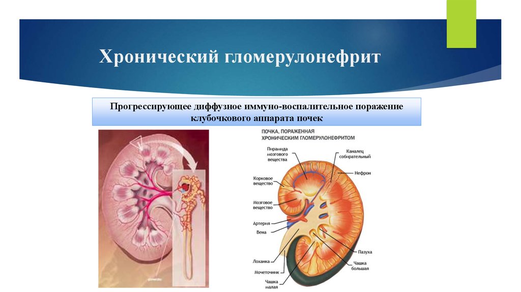 Гломерулонефрит это. Хронический гломерулонефрит нефротический форма. Хронический диффузный гломерулонефрит. Почечные симптомы подострого гломерулонефрита. Гломерулонефрит острый подострый и хронический.