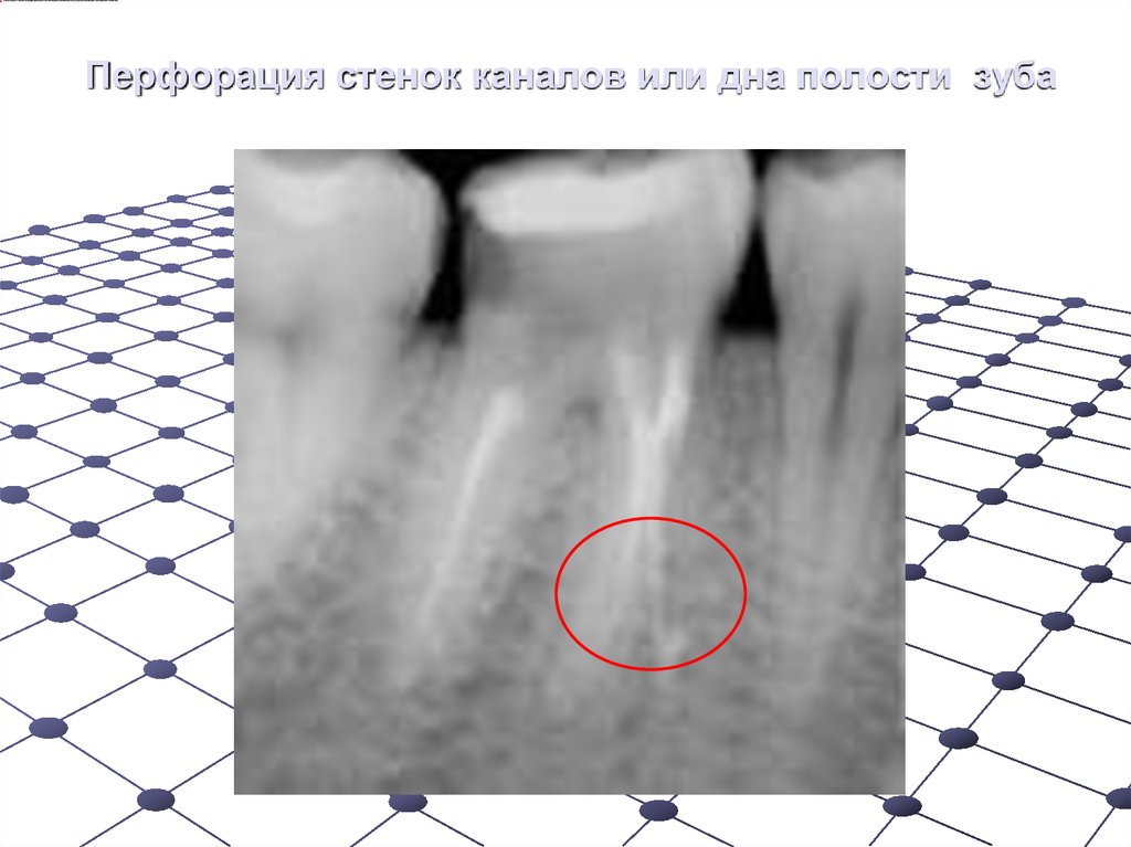 Перфорация стенки это